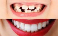 ویژگی های کامپوزیت دندان