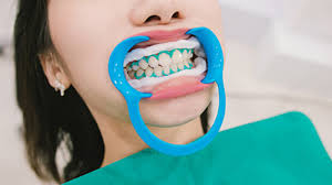 روش های بلیچینگ دندان
