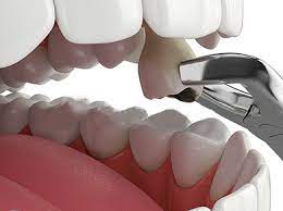روش کشیدن دندان