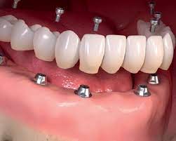 انواع روش کاشت دندان