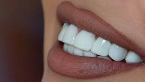 لمینیت دندان چقدر طول می کشد؟
