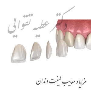 معایب و مزایای لمینت دندان