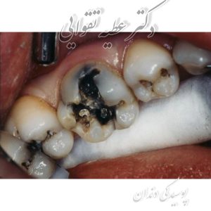 علت پوسیدگی دندان چیست؟