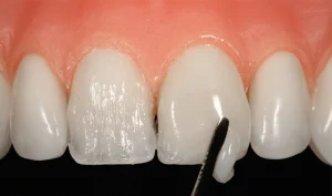 لیرینگ کامپوزیت دندان