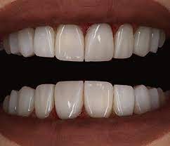 کامپوزیت دندان با روش لیرینگ